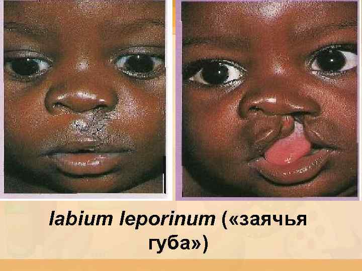 labium leporinum ( «заячья губа» ) 