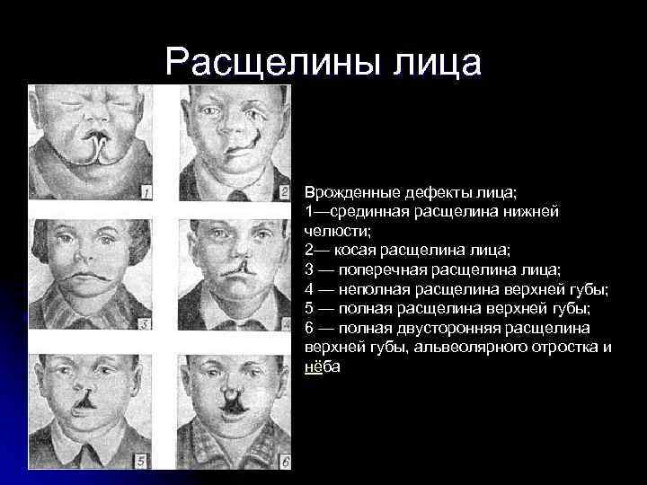 Расщелины лица Врожденные дефекты лица; 1—срединная расщелина нижней челюсти; 2— косая расщелина лица; 3