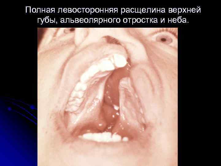 Полная левосторонняя расщелина верхней губы, альвеолярного отростка и неба. 