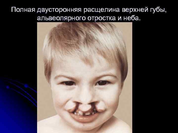 Полная двусторонняя расщелина верхней губы, альвеолярного отростка и неба. 