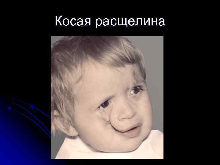 Косая расщелина 