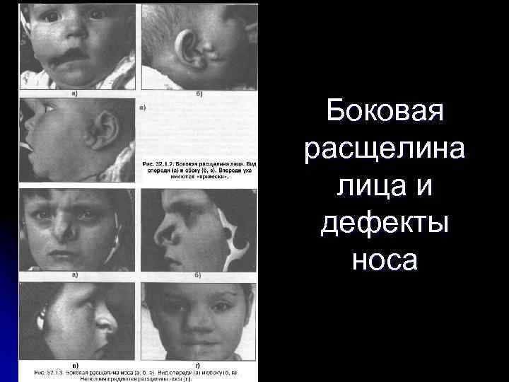 Боковая расщелина лица и дефекты носа 
