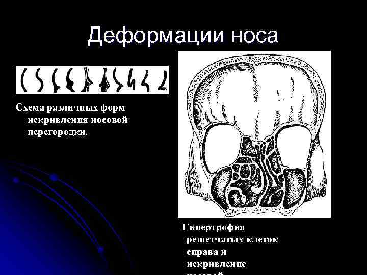 Деформации носа Схема различных форм искривления носовой перегородки. Гипертрофия решетчатых клеток справа и искривление