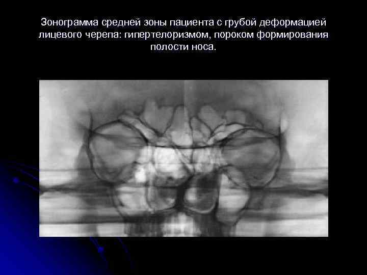 Зонограмма средней зоны пациента с грубой деформацией лицевого черепа: гипертелоризмом, пороком формирования полости носа.