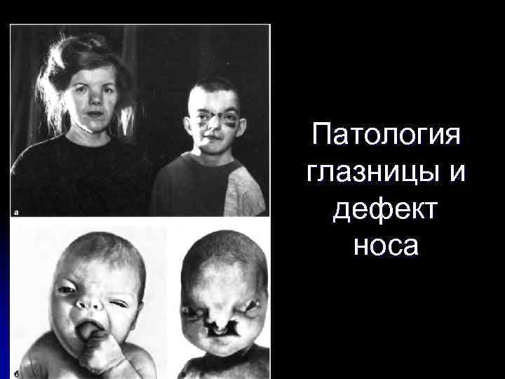 Патология глазницы и дефект носа 