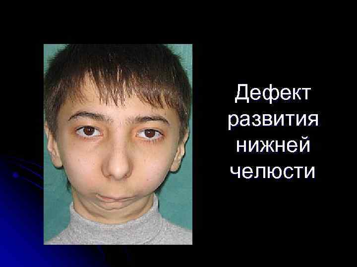 Дефект развития нижней челюсти 
