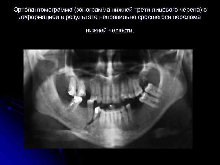 Ортопантомограмма (зонограмма нижней трети лицевого черепа) с деформацией в результате неправильно сросшегося перелома нижней