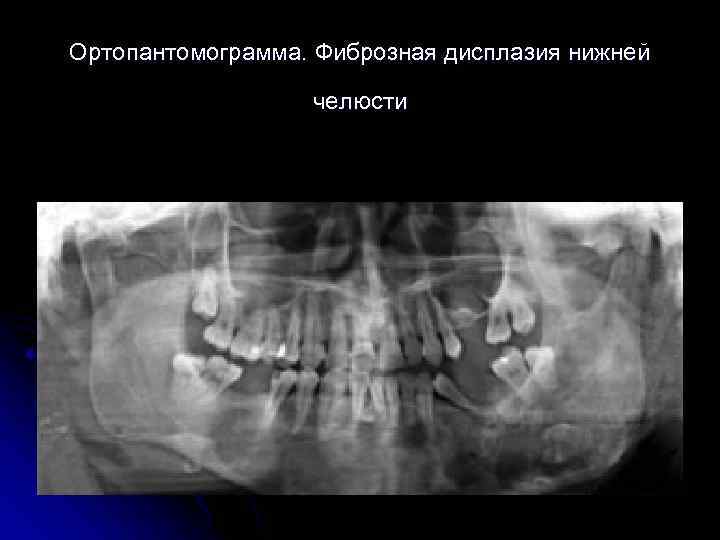 Ортопантомограмма. Фиброзная дисплазия нижней челюсти 