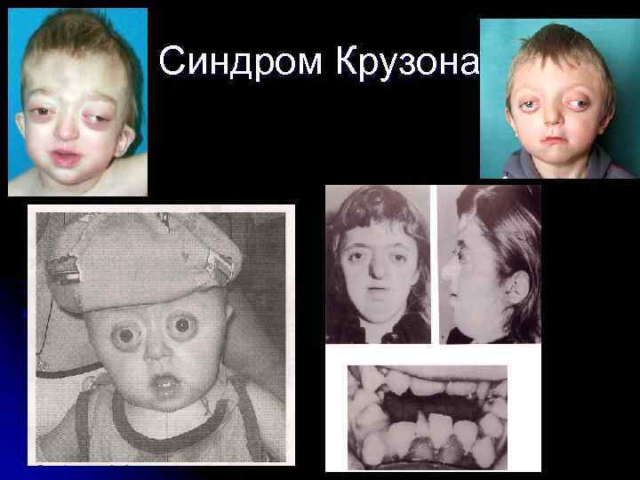 Синдром Крузона 