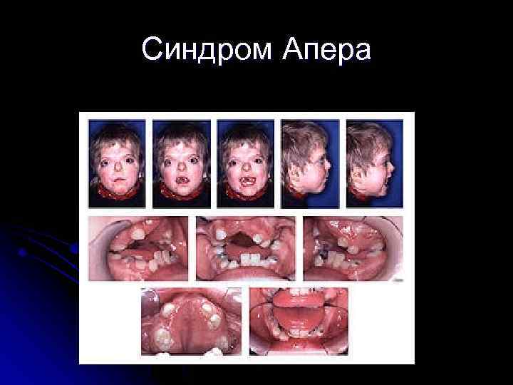 Синдром Апера 