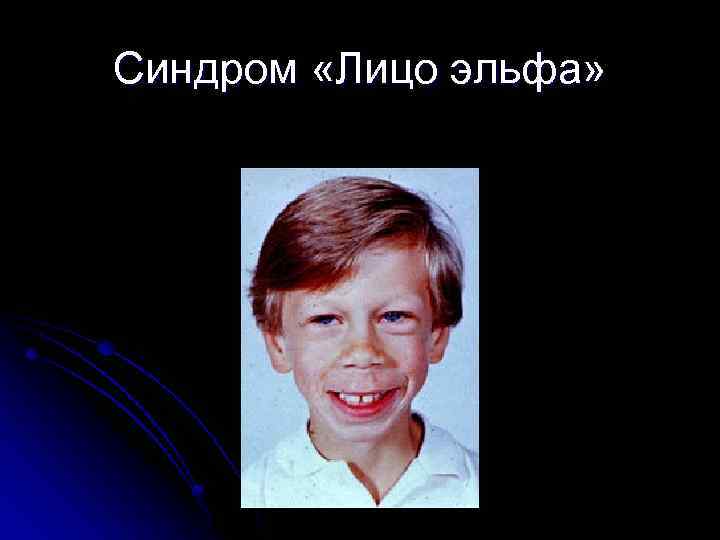 Синдром «Лицо эльфа» 