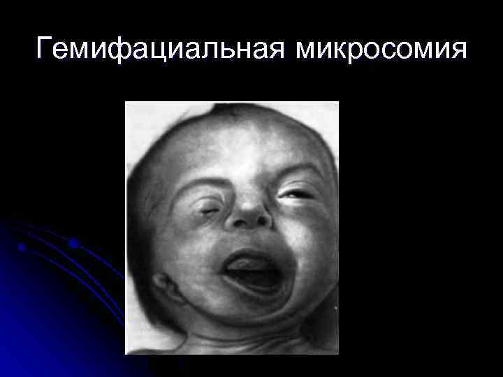 Гемифациальная микросомия 