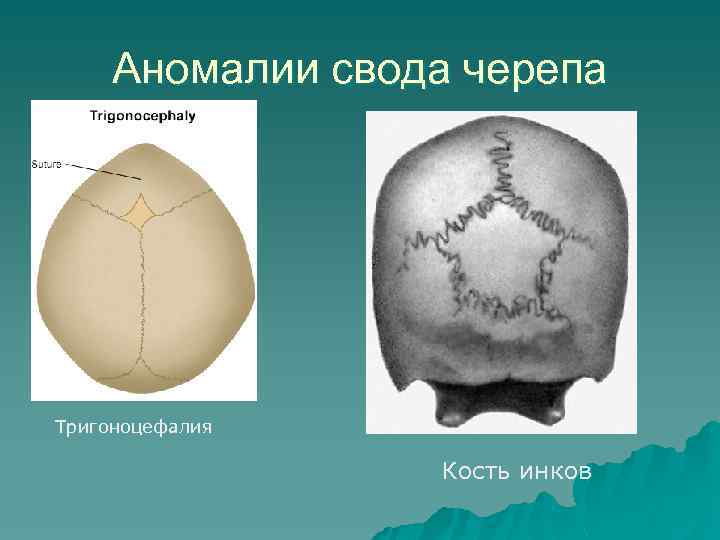 Аномалии свода черепа Тригоноцефалия Кость инков 