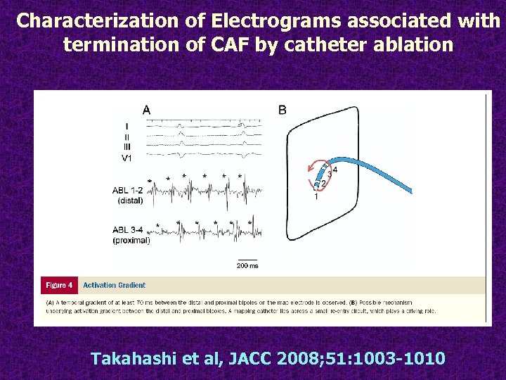 Characterization of Electrograms associated with termination of CAF by catheter ablation Takahashi et al,