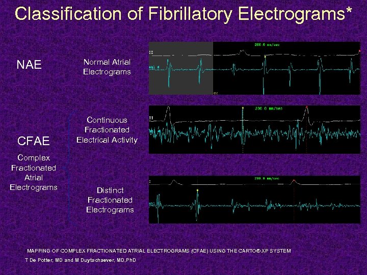 Classification of Fibrillatory Electrograms* NAE CFAE Complex Fractionated Atrial Electrograms Normal Atrial Electrograms Continuous