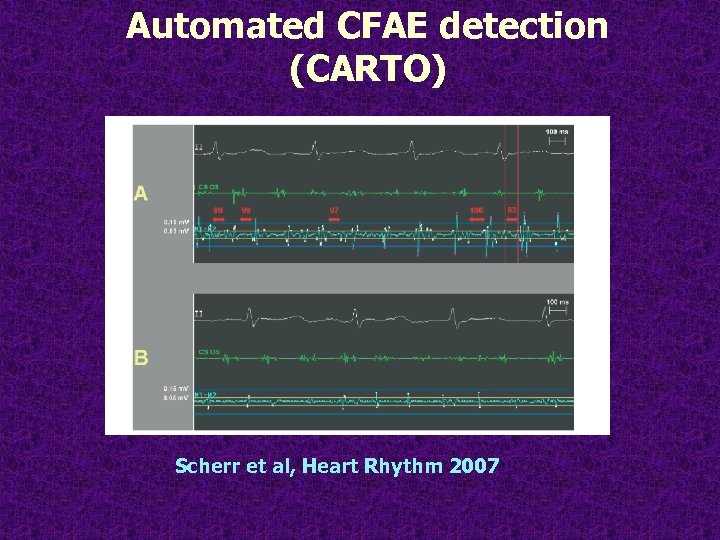 Automated CFAE detection (CARTO) Scherr et al, Heart Rhythm 2007 