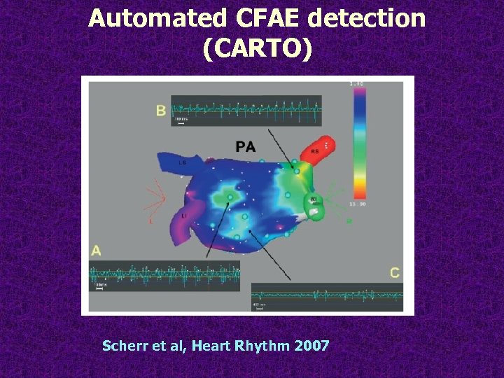 Automated CFAE detection (CARTO) Scherr et al, Heart Rhythm 2007 