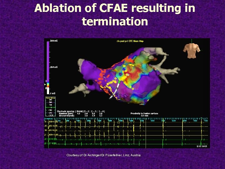 Ablation of CFAE resulting in termination Courtesy of Dr Aichinger/Dr Pürerfellner, Linz, Austria 