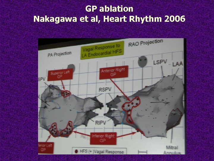 GP ablation Nakagawa et al, Heart Rhythm 2006 