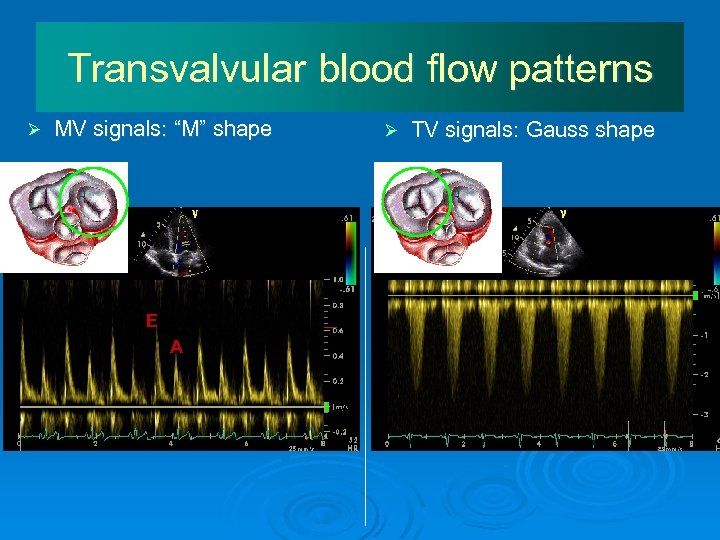 Transvalvular blood flow patterns Ø MV signals: “M” shape E A Ø TV signals: