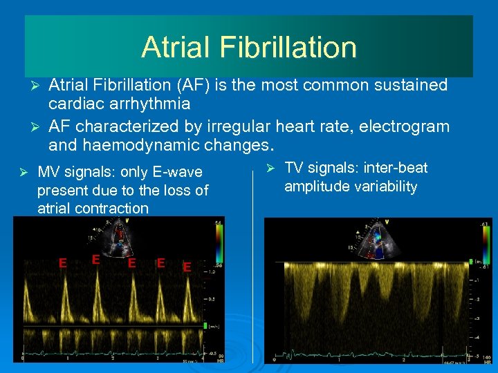 Atrial Fibrillation (AF) is the most common sustained cardiac arrhythmia Ø AF characterized by