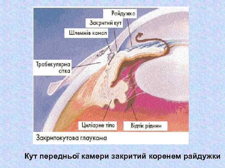 Кут передньої камери закритий коренем райдужки 