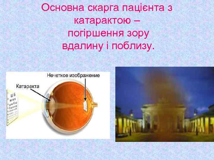 Основна скарга пацієнта з катарактою – погіршення зору вдалину і поблизу. 