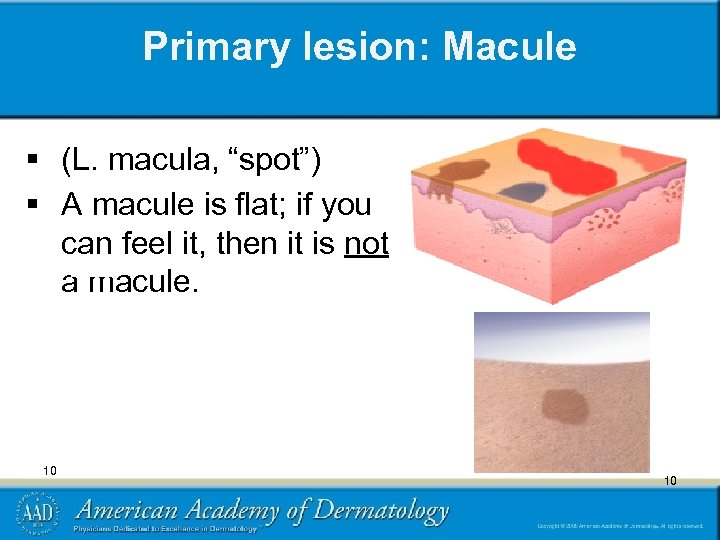 Primary lesion: Macule § (L. macula, “spot”) § A macule is flat; if you