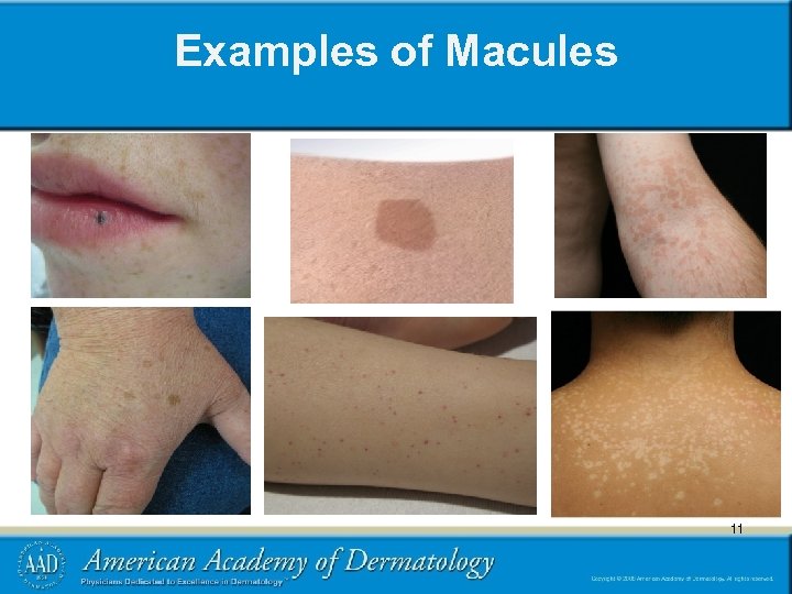 Examples of Macules 11 11 