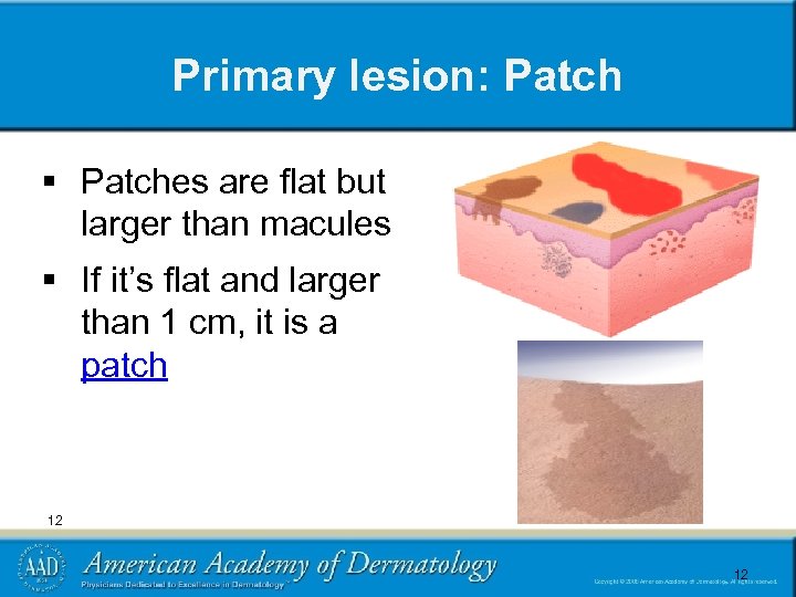 Primary lesion: Patch § Patches are flat but larger than macules § If it’s