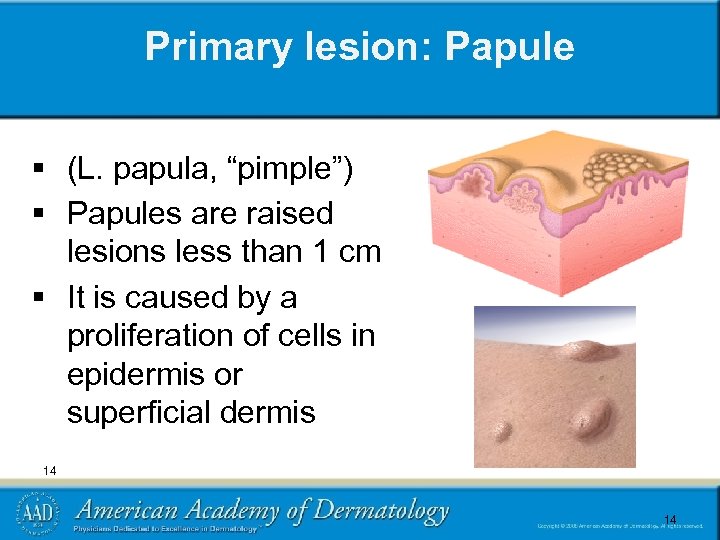 Primary lesion: Papule § (L. papula, “pimple”) § Papules are raised lesions less than