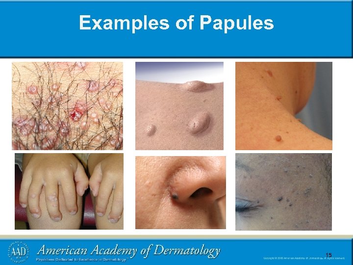 Examples of Papules 15 15 