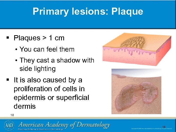 Primary lesions: Plaque § Plaques > 1 cm • You can feel them •