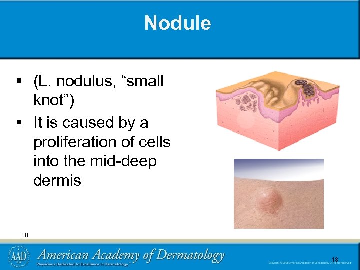 Nodule § (L. nodulus, “small knot”) § It is caused by a proliferation of