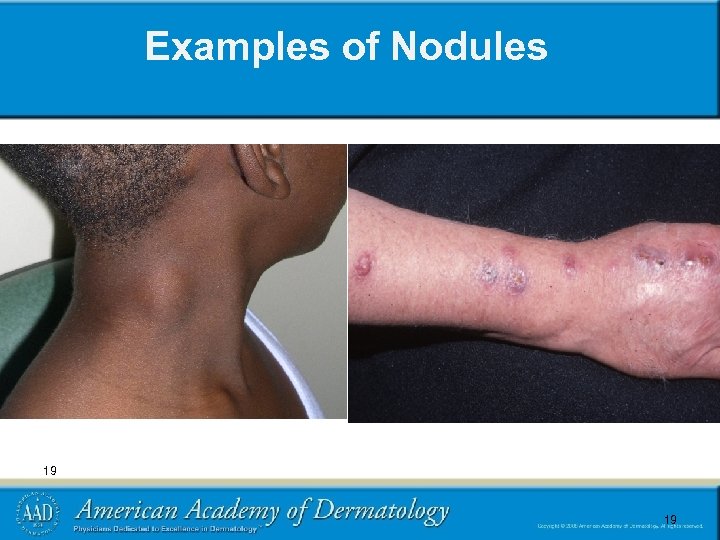 Examples of Nodules 19 19 