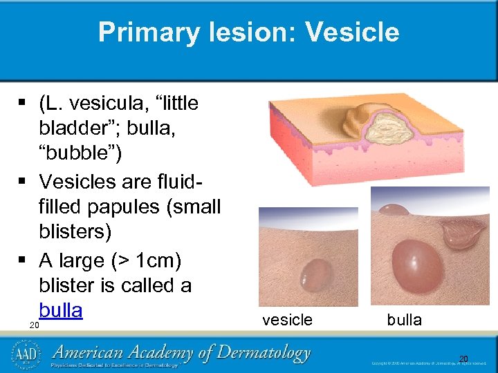 Primary lesion: Vesicle § (L. vesicula, “little bladder”; bulla, “bubble”) § Vesicles are fluidfilled