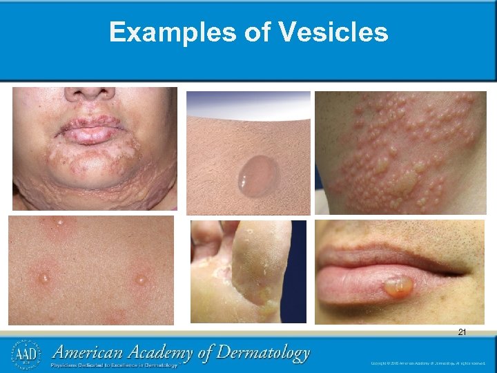 Examples of Vesicles 21 21 