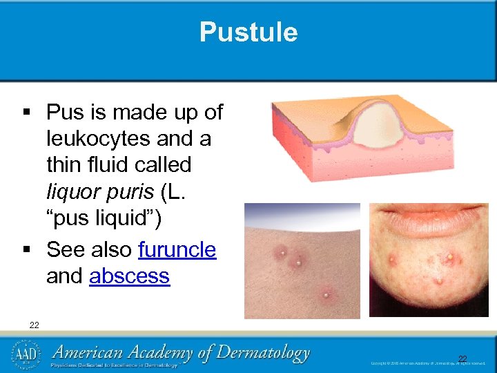 Pustule § Pus is made up of leukocytes and a thin fluid called liquor