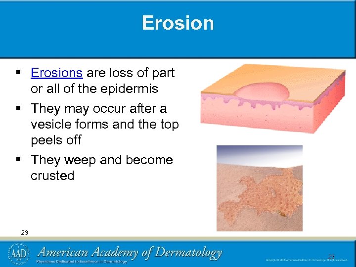 Erosion § Erosions are loss of part or all of the epidermis § They