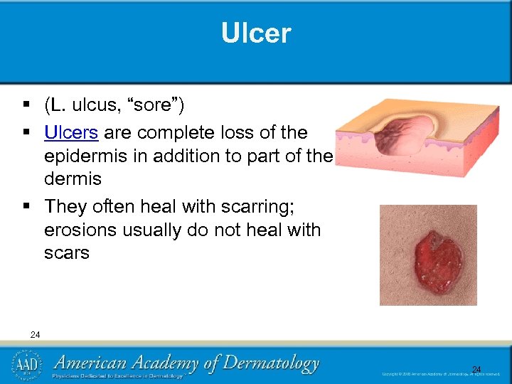 Ulcer § (L. ulcus, “sore”) § Ulcers are complete loss of the epidermis in