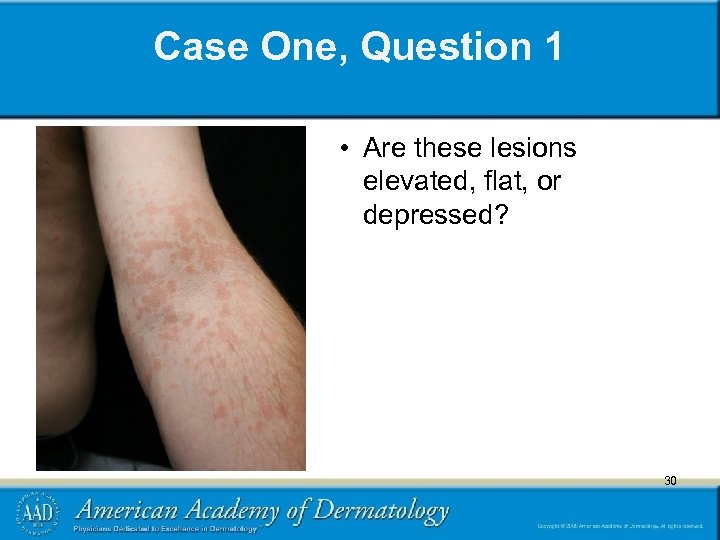 Case One, Question 1 • Are these lesions elevated, flat, or depressed? 30 30