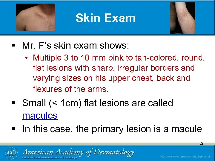 Skin Exam § Mr. F’s skin exam shows: • Multiple 3 to 10 mm