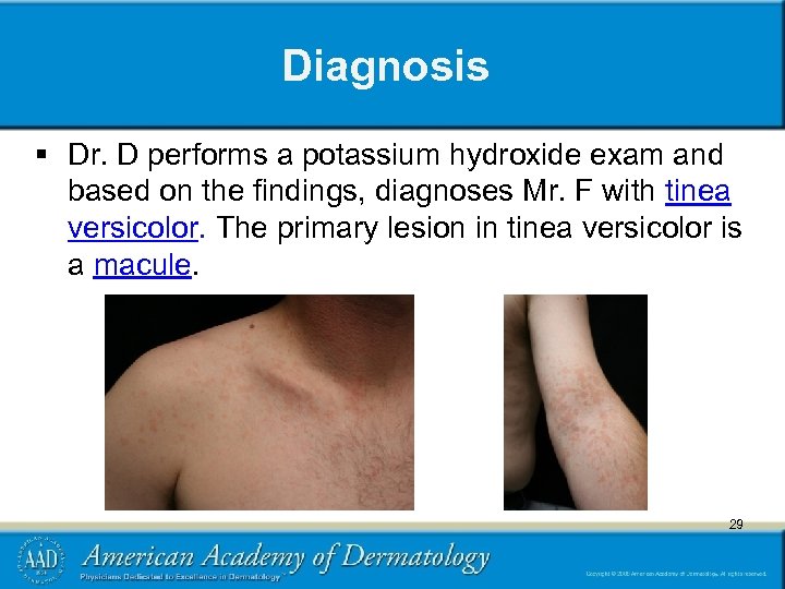 Diagnosis § Dr. D performs a potassium hydroxide exam and based on the findings,