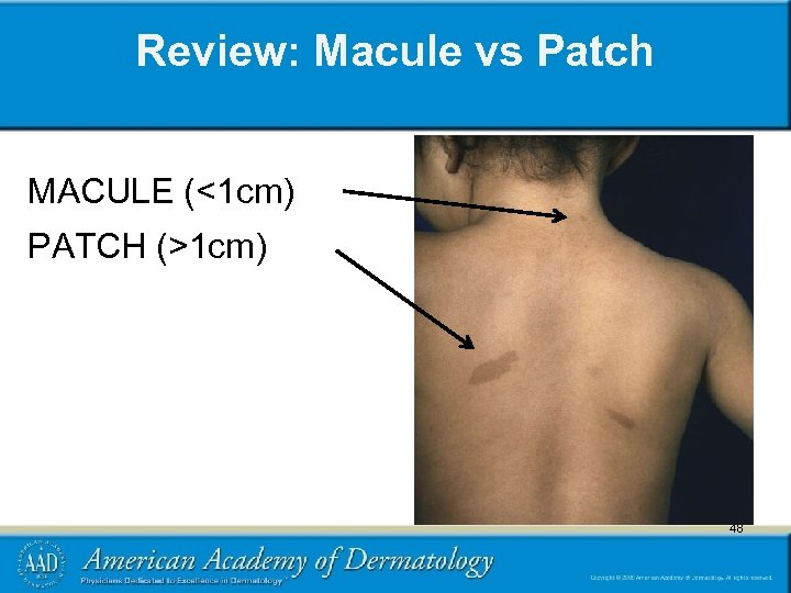 Review: Macule vs Patch MACULE (<1 cm) PATCH (>1 cm) 48 48 