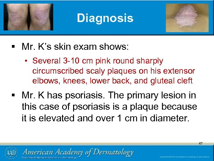 Diagnosis § Mr. K’s skin exam shows: • Several 3 -10 cm pink round