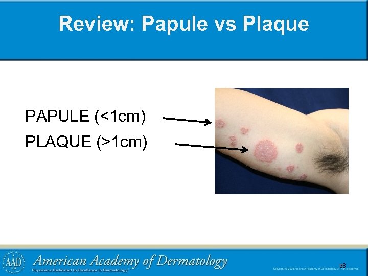 Review: Papule vs Plaque PAPULE (<1 cm) PLAQUE (>1 cm) 58 58 