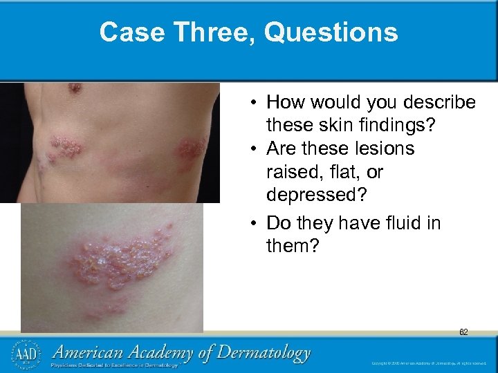 Case Three, Questions • How would you describe these skin findings? • Are these