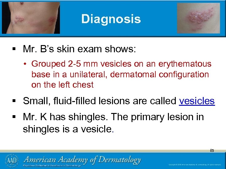 Diagnosis § Mr. B’s skin exam shows: • Grouped 2 -5 mm vesicles on