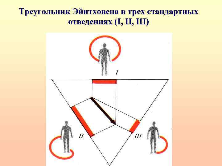 Треугольник Эйнтховена в трех стандартных отведениях (I, III) 