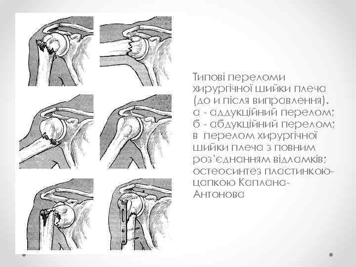 Типові переломи хирургічної шийки плеча (до и після виправлення). а - аддукційний перелом; б